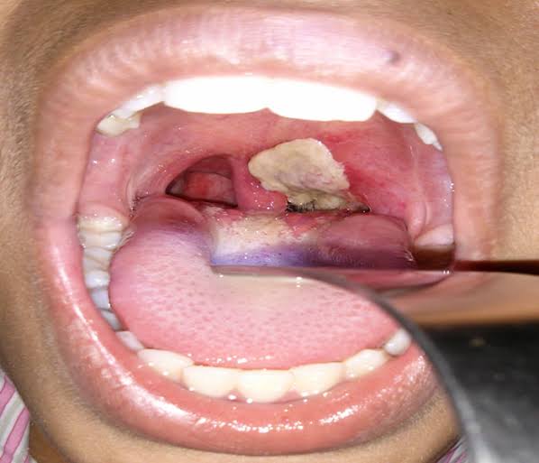 Diphtheria Breaks Out In Edo State, K!lls 2
